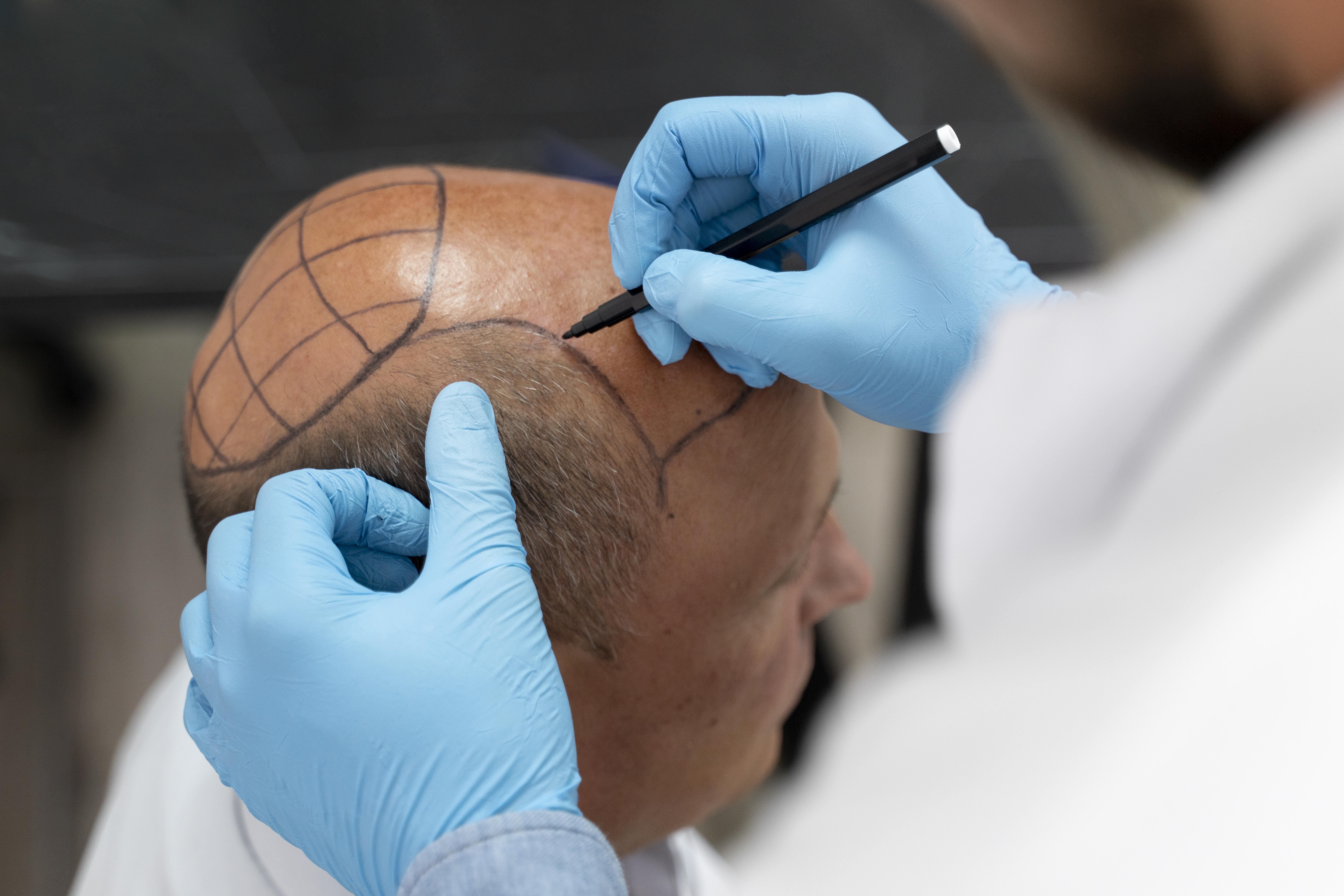 Hızlı İyileşen Saç Ekimi: Doğal Sonuçlarla Kısa Sürede Sağlıklı Saçlara Kavuşun